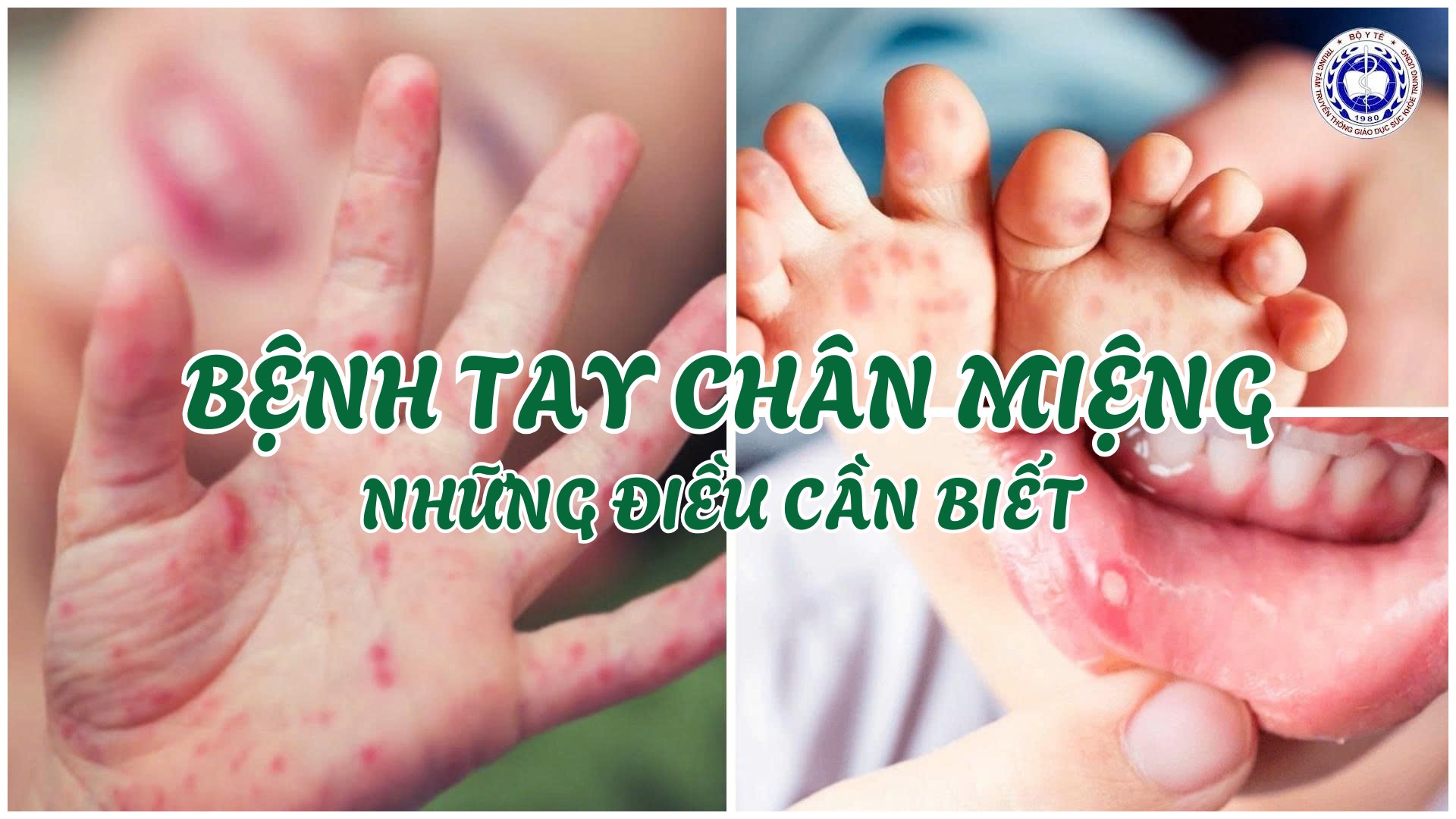 THÔNG ĐIỆP / KHUYẾN CÁO: BỆNH TAY CHÂN MIỆNG - NHỮNG ĐIỀU CẦN BIẾT