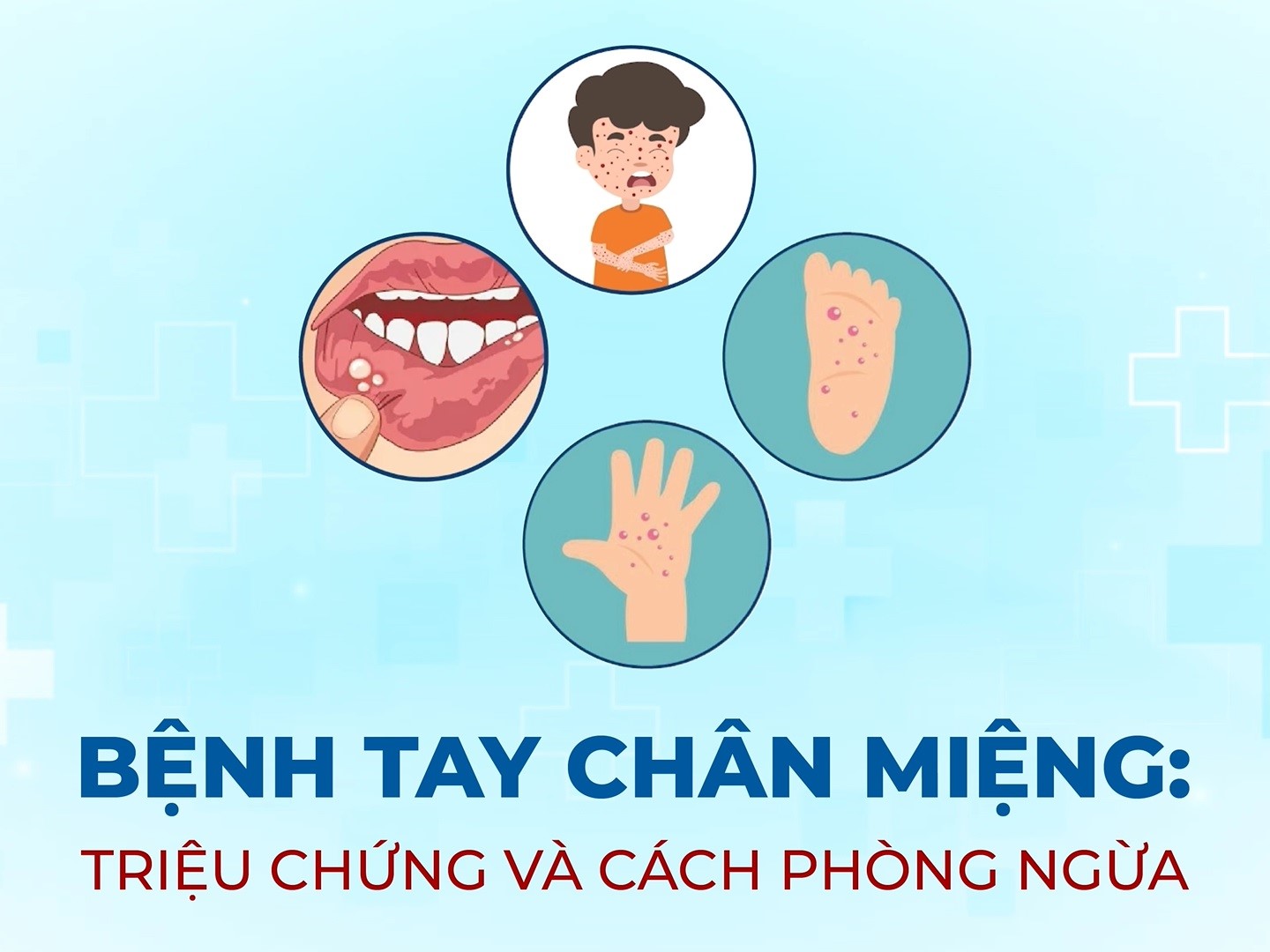 BỆNH TAY CHÂN MIỆNG: TRIỆU CHỨNG VÀ CÁCH PHÒNG NGỪA